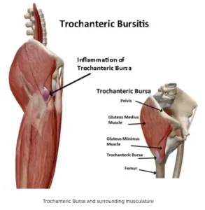 Gainesville Georgia Physical Therapy Hip Bursitis