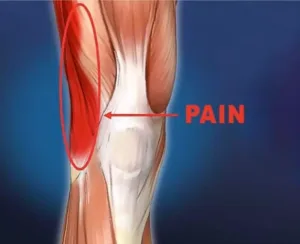 Gainesville Georgia Physical Therapy Runners Knee Pain